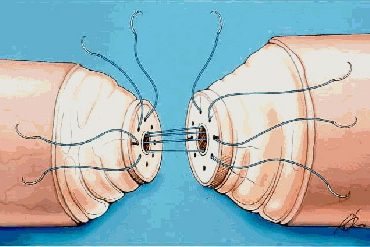 Vasectomia